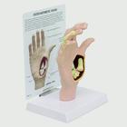 Osteoarthritis Hand Model 1