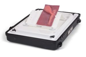 Gall Bladder with Wide Common Bile Duct & Stones for Exploration