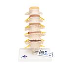 Stages of Disc Prolapse and Vertebral Degeneration