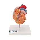 Classic Human Heart Model with Left Ventricular Hypertrophy (LVH), 2 part