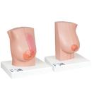 Model of Female Breast with Healthy & Unhealthy Tissue