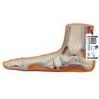 Flat Foot (Pes Planus) Model