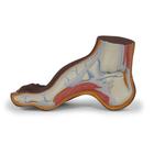 Hollow Foot (Pes Cavus) Model, dark skin