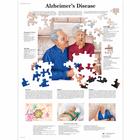 Alzheimer's Disease Chart