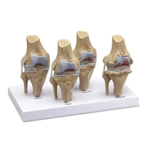 SKU: MG20228  Knee Joint with Pathologies Model, 4-Stages