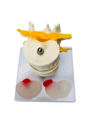 SKU: MG19848  Two Lumbar Vertebrae with Herniation and Prolapse Model