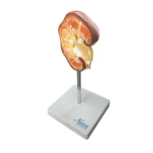 SKU: MG21415  Kidney Stone (Nephrolites) Model