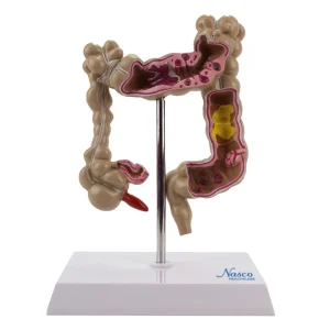 SKU: MG21850  Colon with Intestinal Pathologies Model