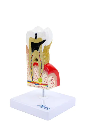SKU: MG22727  Dental Disease Model, 10X Enlarged