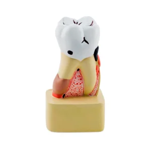 SKU: MG22728  Dental Disease Model, 4X Enlarged