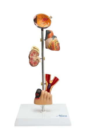 SKU: MG22746  Effects of Diabetes Model, 5 Parts