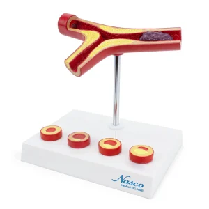 SKU: MG29729  Arteriosclerosis & Thrombosis with Artery Cross Section Model