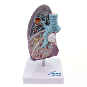 SKU: MG30885  Lung with Pathology Model, 1.5X Enlarged