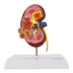 SKU: MG31019  Kidney with Pathology Model, 2-1/2X Enlarged
