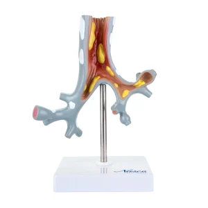 SKU: MG31098  Bronchial Tree Section with Pathology Model, 10X Enlarged