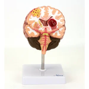 SKU: MG31100  Brain Section with Pathology Model