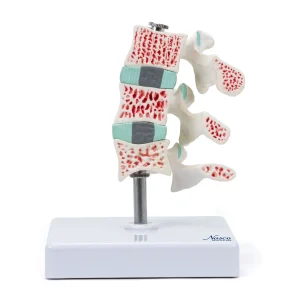 SKU: MG32226  Deluxe Osteoporosis Model, 3 Parts