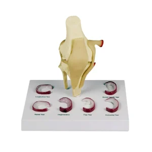SKU: MG35506  Meniscus Knee with 6 Tears Model
