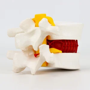 SKU: MG35510  Herniated Disc Demonstration Model