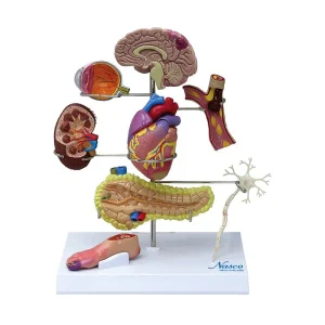 SKU: MG35532  Effects of Type II Diabetes Model