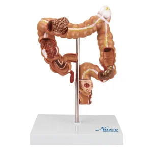 SKU: MG35589  Intestinal Pathologies of Colon & Rectum Model