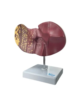 SKU: MG36148  Liver Section with Pathology Model