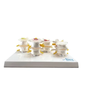 SKU: MG36171  Lumbar Vertebrae Model, 4 Stages