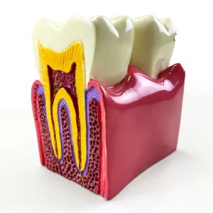 SKU: MG39442  Dental Disease Model, 6X Enlarged