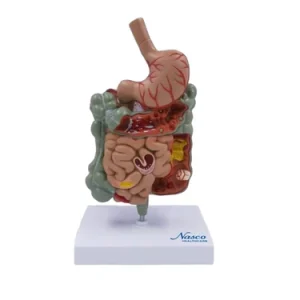 SKU: MG39708  Gastrointestinal Tract with Pathologies Model