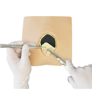 MW63  Necrotic tissue removal set