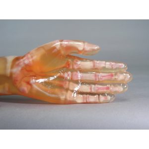 PH-2  Fractured Hand/Forearm Phantom PH-2/ 2B