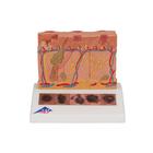 Skin Cancer Model with 5 stages, 8 times magnified