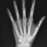 X-Ray Phantom Hand, opaque