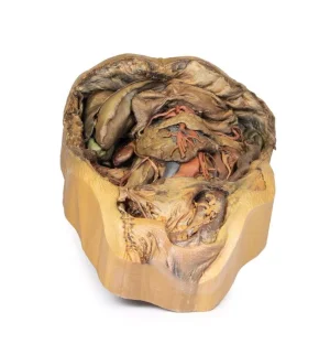 Abdomen with inguinal hernia