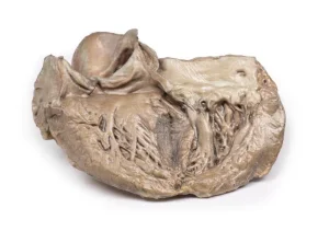 Bicuspid Aortic Valve