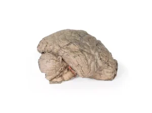 Brain Hemisection