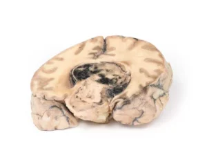 Glioblastoma multiforme