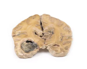 Glioblastoma multiforme
