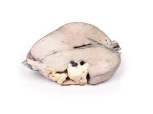 Hepatic duct calculi and Obstructive Biliary Cirrhosis