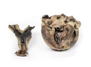 Hydatid Disease Affecting the Heart and Aorta