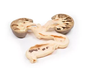 Hydronephrosis Hydroureter