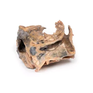 Inhaled Foreign Body—trachea