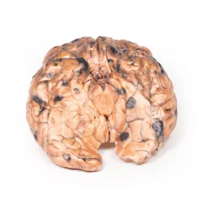 Metastatic melanoma