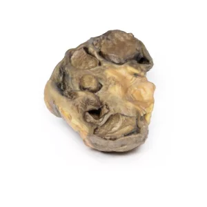 Pyonephrosis