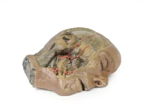 Sagittal Section of head with infratemporal Fossa Dissection