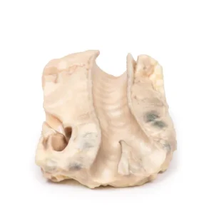 Trachea—Hodgkin Lymphoma