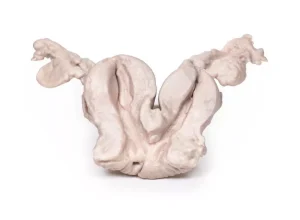 Uterus Bicornuate Unicollis