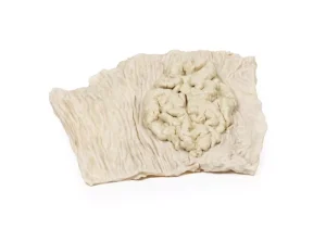 Villous adenoma of colon